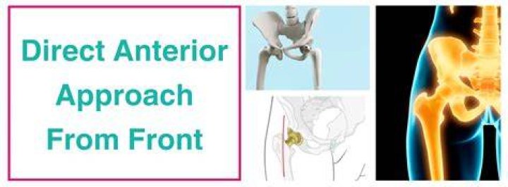 When Would the Direct Anterior Approach for THA Be Contraindicated?